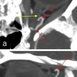 Contrast Enhanced Axial A C E G And Sagittal B D F H Computed