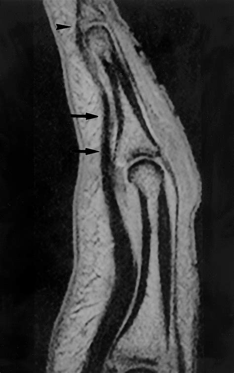 A2 Pulley Finger Mri At Alexandra Duigan Blog