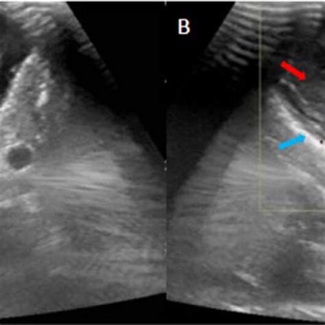 Ultrasound Scrotum A And B Showing A Well Defined Lesion Of Mixed