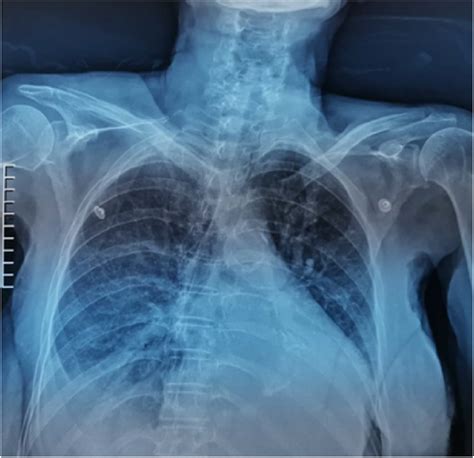 Chest X Ray Showing Enlargement Of The Heart Pulmonary Congestion And