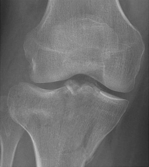 Schatzker Classification Of Tibial Plateau Fractures Use Of Ct And Mr