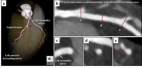 Figure 2 From Spontaneous Coronary Artery Intramural Hematoma In A