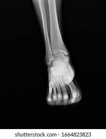 Xray Right Ankle Showing Spiral Fracture Stock Photo Edit Now