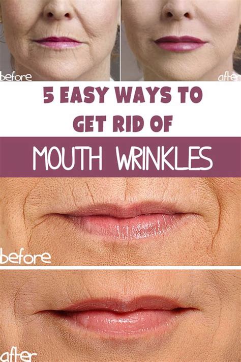 Ways To Get Rid Of Wrinkles Around The Mouth Healthytips