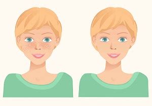 how to naturally get freckles