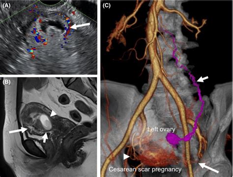 A Transvaginal Ultrasonography Showing A Heterogeneous Mass With