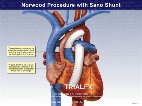 Norwood Procedure With Sano Shunt TrialQuest Inc