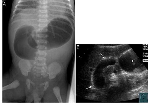 Intestinal Malrotation And Midgut Volvulus Image