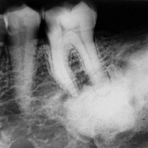 Orthopantomogram Showing Multiple Well Defined Sclerotic Masses With