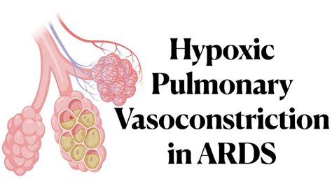 Hypoxic Pulmonary Vasoconstriction In Ards Youtube