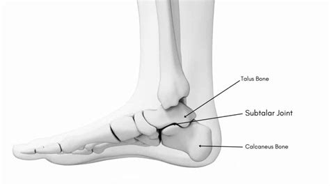 Subtalar Joint Arthritis: explained by a Foot Specialist