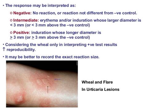 Allergy Testing