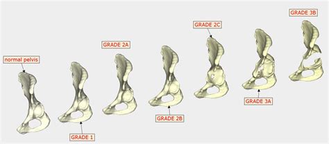 Datei Stl Paprosky Klassifikation Des H Ftgelenkknochenverlustes