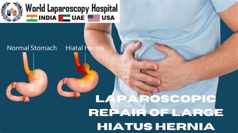 Hiatal Hernia Repair Laparoscopic