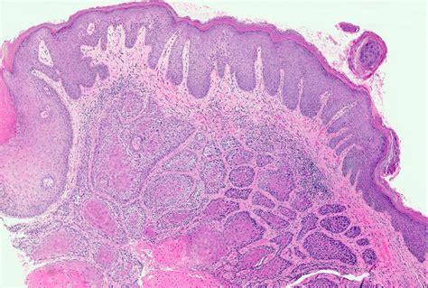 Vulvar Squamous Cell Carcinoma