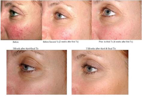 laser_rosacea - Abby Medical Laser Centre