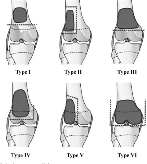 Figure From Biological Reconstruction After Excision Of Juxta