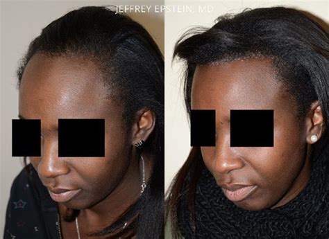 Forehead Reduction Surgery Photos Miami FL Patient37310