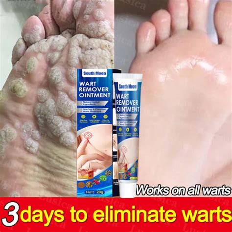 100 Effective Original South Moon South Moon Warts Remover Original