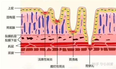 胃溃疡和胃糜烂的区别 知乎