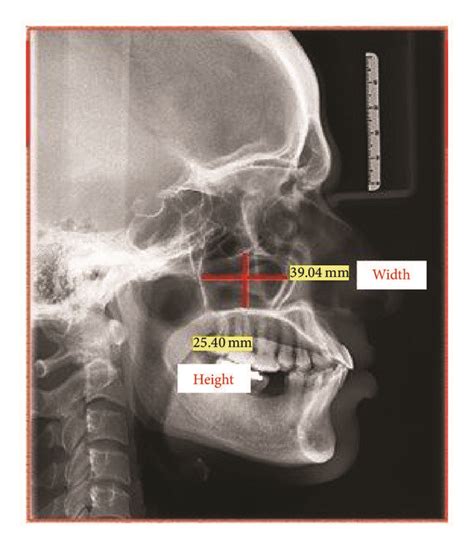 Maxillary Sinus Height And Width Measurements Radiographically Using