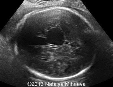 📃 Vein of Galen malformation