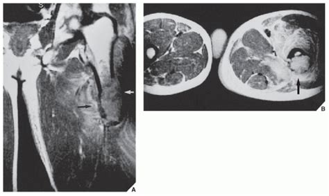 Benign Tumors And Tumor Like Lesions Iii Fibrous Fibroosseous And