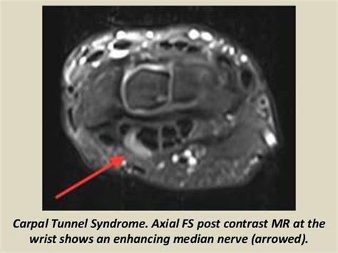 [View 32+] Download Carpal Tunnel Syndrome Mri Radiology Background jpg