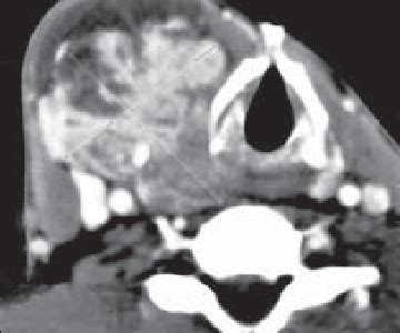 C T Scan Of The Neck Showing A Solid Cystic Mass Involving The Right