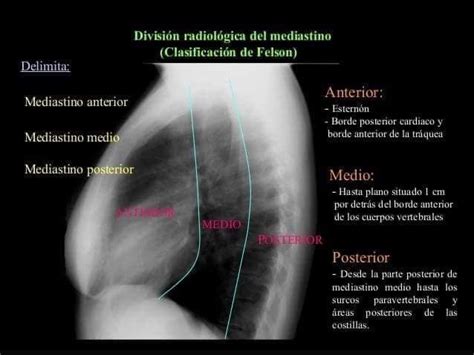 RX Mediastino Divisjon