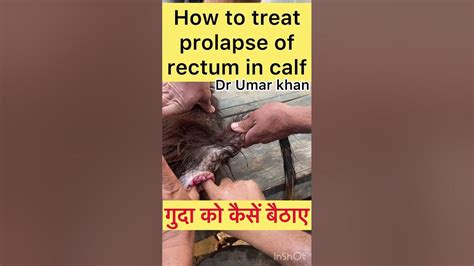 Prolapse Of Rectum L Dr Umar Khan Youtube