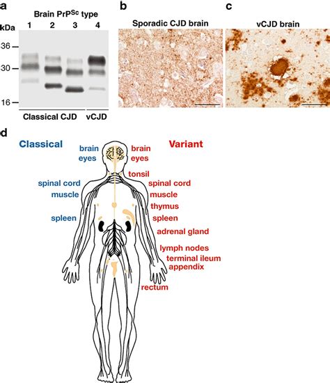 Diagnosis Of Creutzfeldt Jakob Disease An Overview 45 OFF