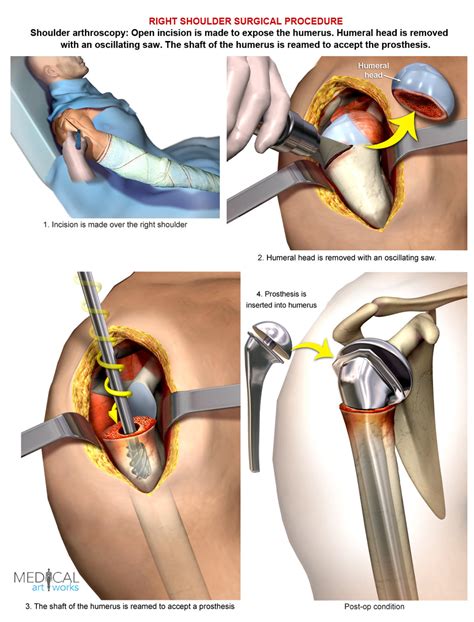 Right shoulder - Arthroplasty, Shoulder replacement – Medical Art Works