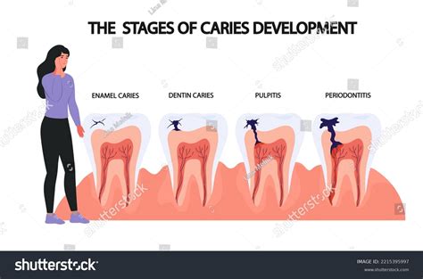 Stages Of Tooth Decay Over 332 Royalty Free Licensable Stock Vectors