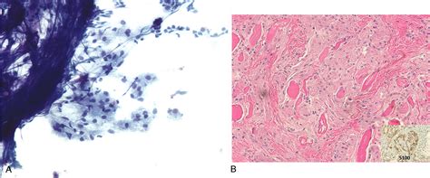 Table 1 From Fine Needle Aspiration Diagnosis Of Non Epithelial Lesions