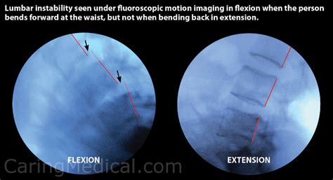 Types Of Conservative Care Treatments And Spinal Injections For Low