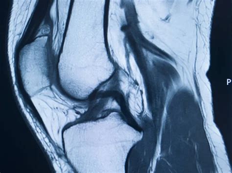 Knee injury mri mcl tear — Stock Photo © edwardolive #308025368