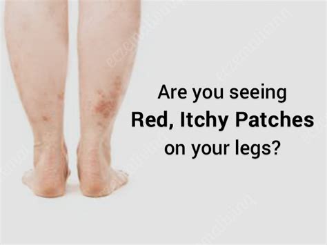 Eczema Rash On Legs Treatment