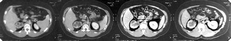 Abdominal Computed Tomography Image Showing Pyelocaliceal Dilation And