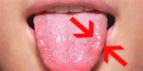 Aprenda C Mo Puede Eliminar Naturalmente Los Hongos En Su Lengua Hoy