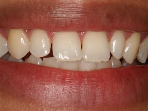 Changing the Size and Shape of Teeth with Veneers - PureCare Dental