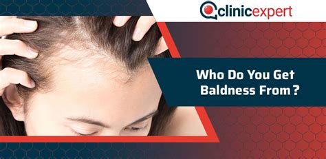 Who Do You Get Baldness From Clinicexpert