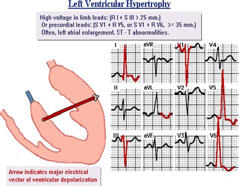 Left Ventricular Hypertrophy Ecg