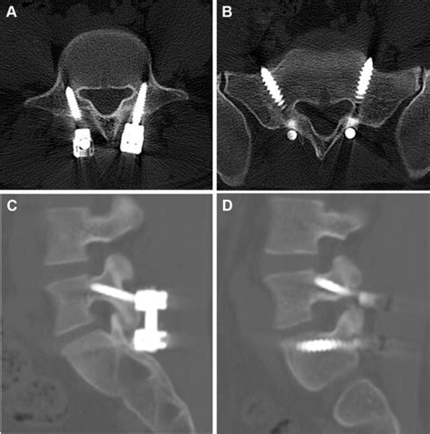 The Comparison Of Pedicle Screw And Cortical Screw In Posterior Lumbar