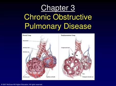 Ppt Chapter 3 Chronic Obstructive Pulmonary Disease Powerpoint