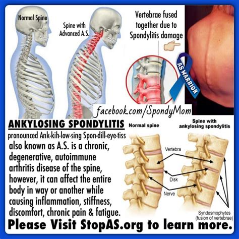 Pin On Ankylosing Spondylitis