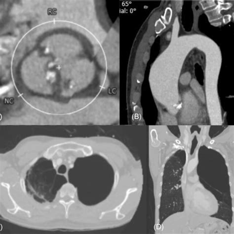 Preoperative Multislice Computed Tomography Ct Preoperative Ct