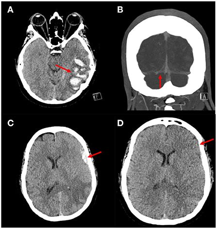 Frontiers Cerebral Venous Sinus Thrombosis With An Acute Subdural