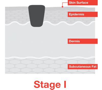 Malignant Melanoma Stage 1