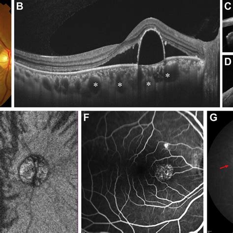 Images Of The Right Eye Of A Year Old Man With Central Serous